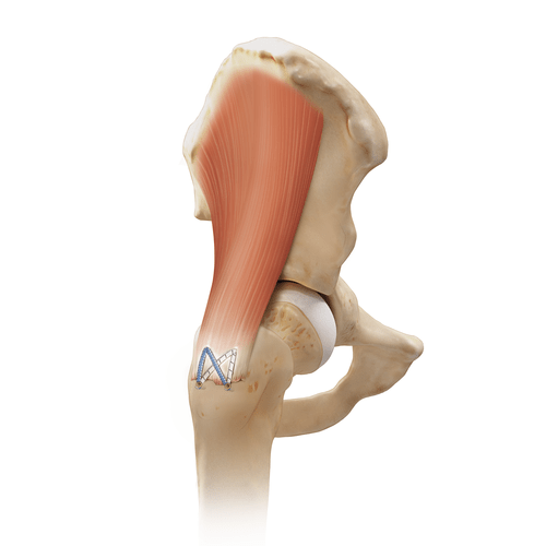 Abductor Tear Abductor Tear