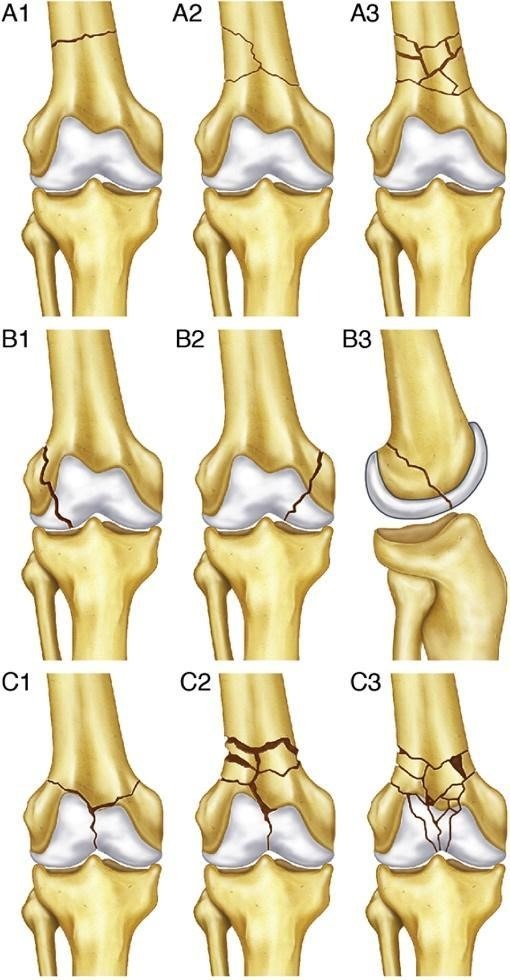 Distal Femur Fracture Distal Femur Fracture