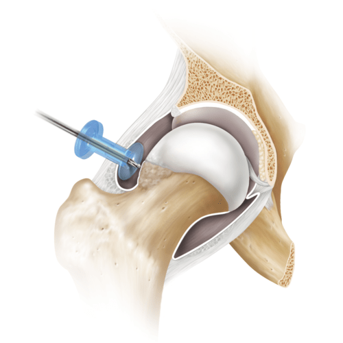 hip impingement