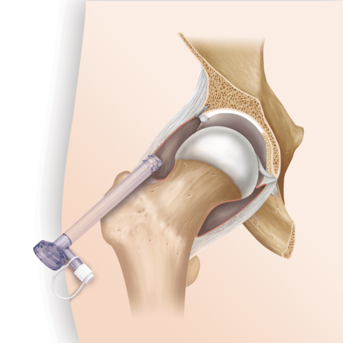Ligamentum Teres Rupture Ligamentum Teres Rupture