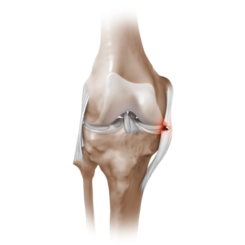 Medial Collateral Ligament knee tear