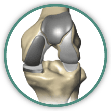 partial knee replacement