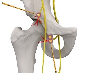 coolief radiofrequency