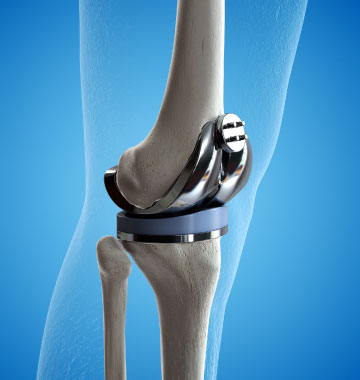 knee replacement knee replacement