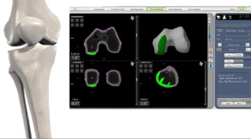 robotic partial knee replacement