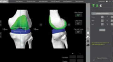 robotic partial knee replacement