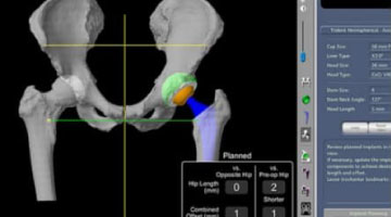 mako hip replacement