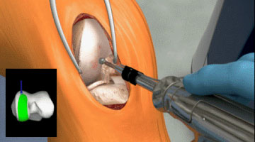 robotic assisted partial knee replacement