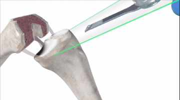 robotic assisted partial knee replacement