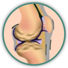 hip arthritis