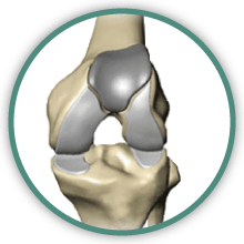 partial knee replacement