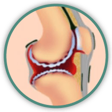 hip arthritis symptoms