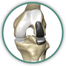 partial knee replacement