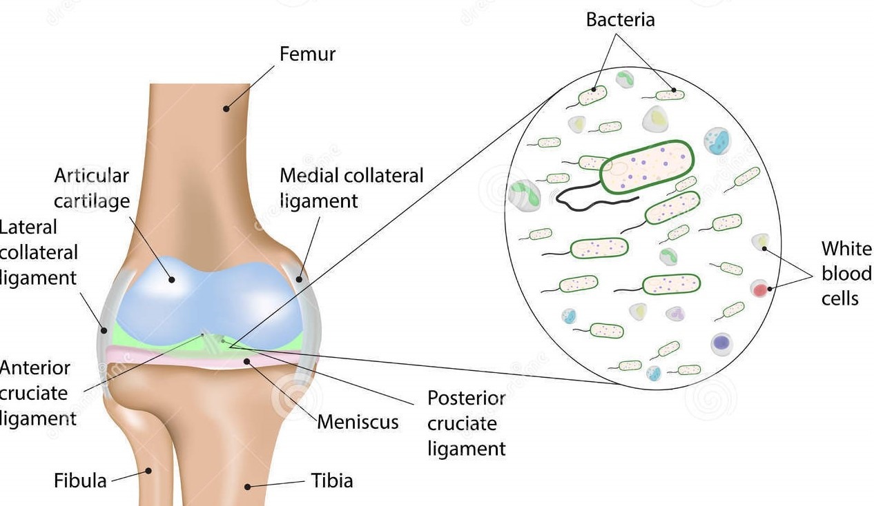 Knee Infections