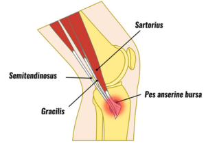 Pes anserine tendonitis