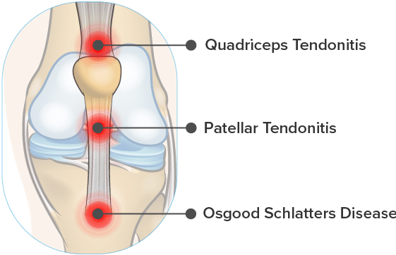 knee inflammation