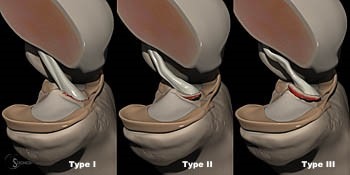 Tibial eminence fracture Tibial eminence fracture