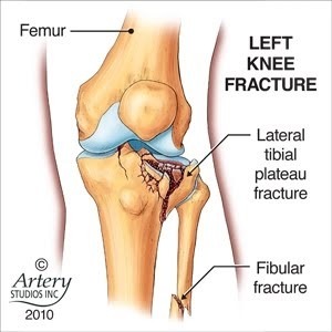 Tibial plateau fracture Tibial plateau fracture