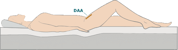 direct anterior approach