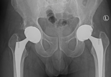 mako hip replacement