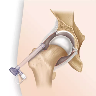 Ligamentum teres tears treatment