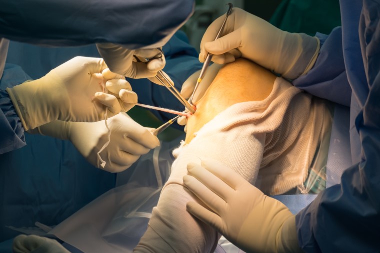 anterior cruciate ligament tear surgery