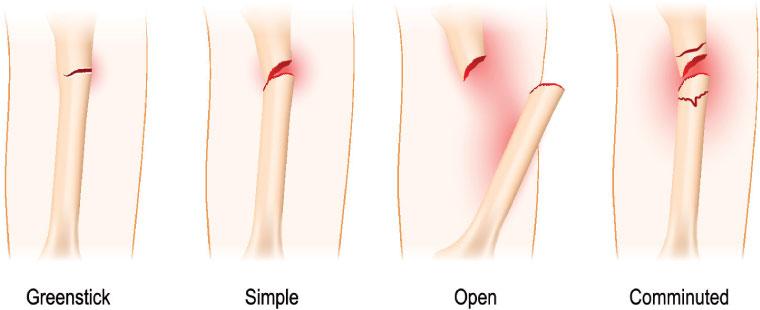 fracture bone treatment