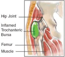 hip Bursitis