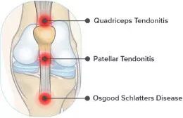 hip Tendonitis