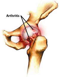 hip arthritis