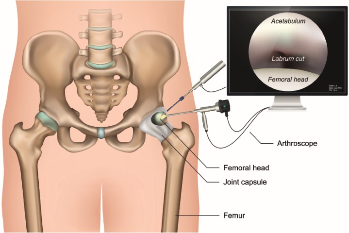 hip labral tear surgery melbourne