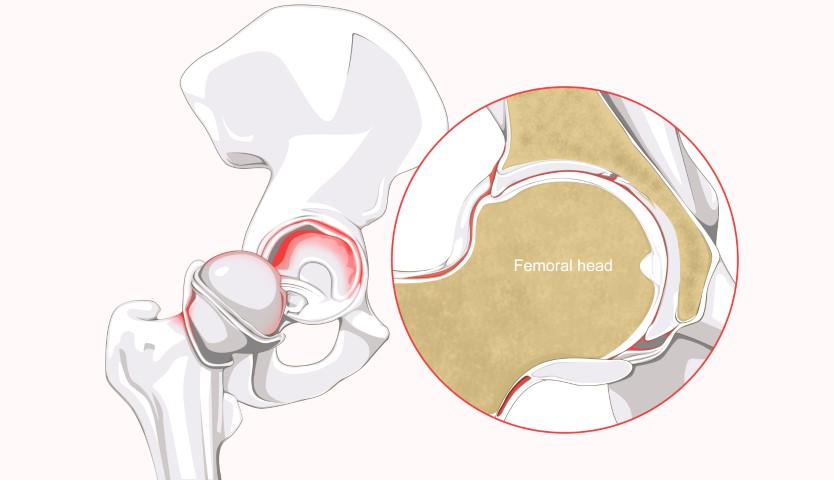 hip labral tear treatment in melbourne