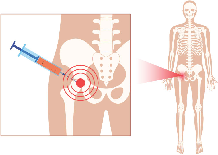 Treatment For Hip Bursitis and Causes Melbourne