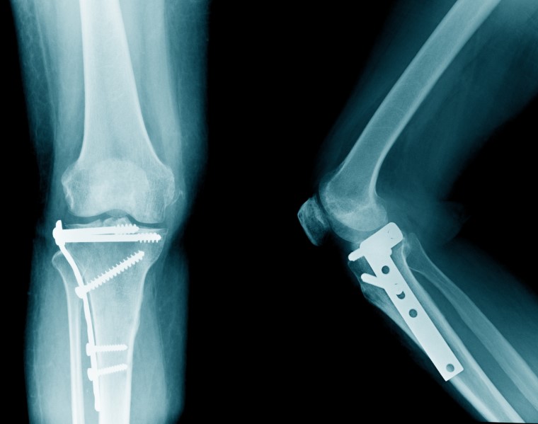 knee fracture surgery