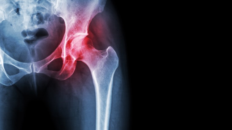 hip fracture repair surgery