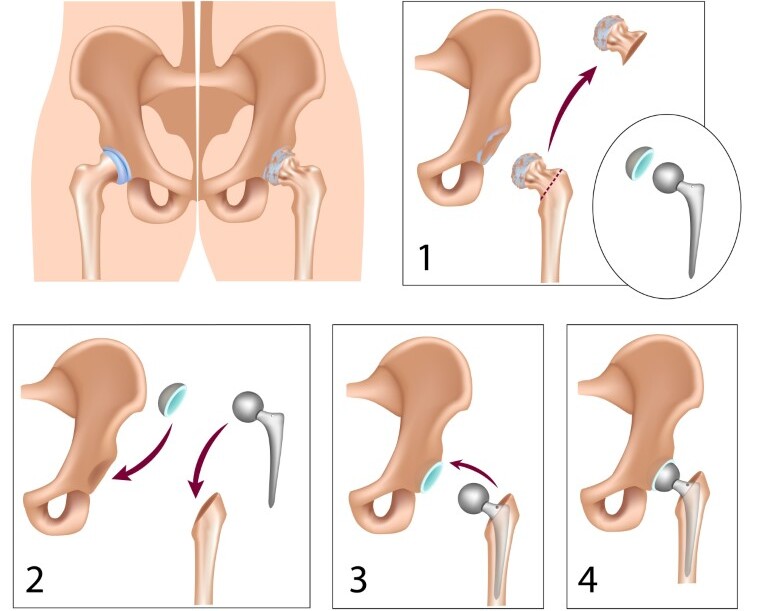 hip arthritis surgery 