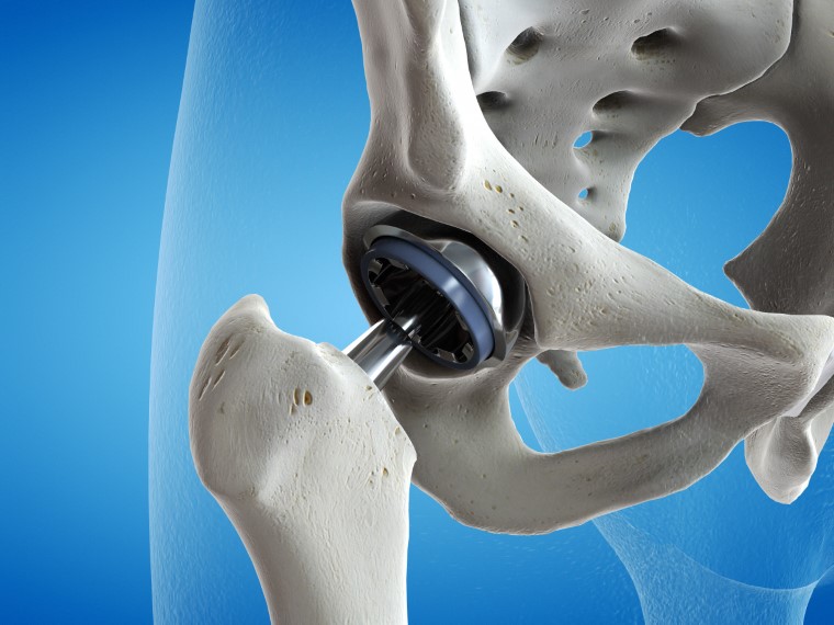 hip replacement surgery melbourne