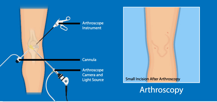 Knee Arthroscopy Melbourne