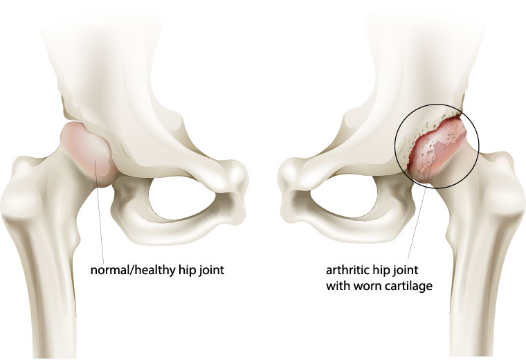 hip arthritis