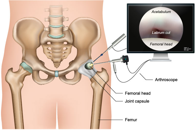 hip arthroscopy