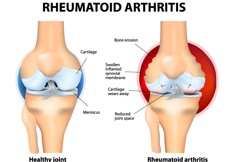 hip arthritis surgery 