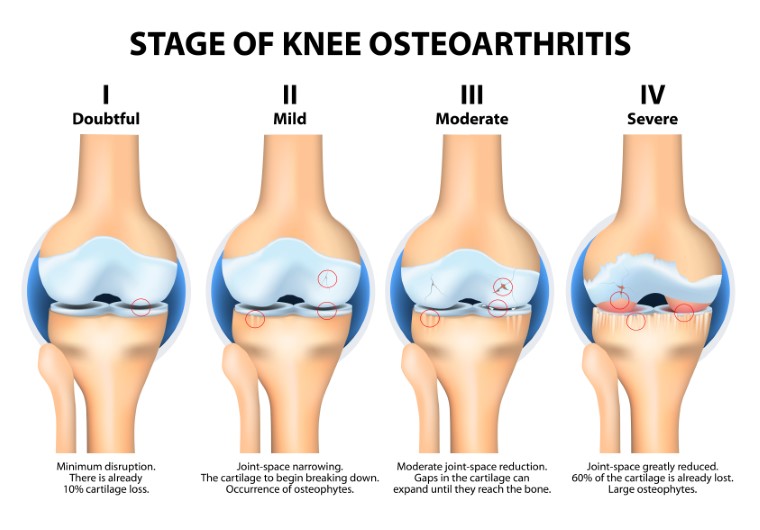 knee arthritis surgery