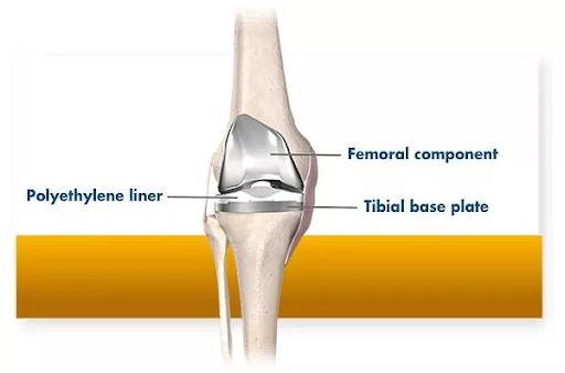 knee replacement surgery melbourne