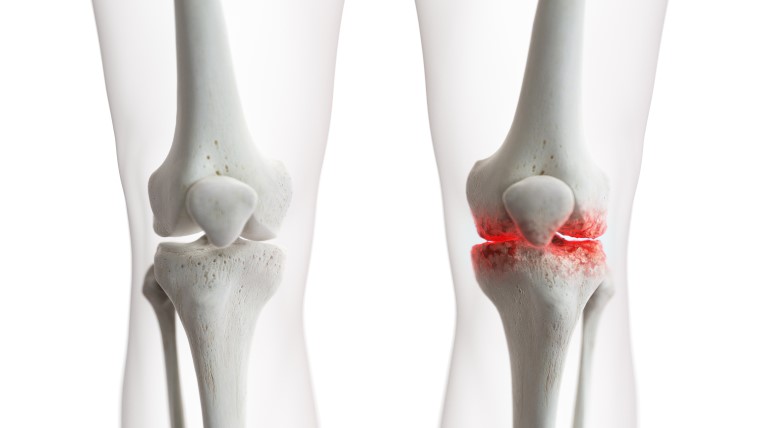 hip arthritis 