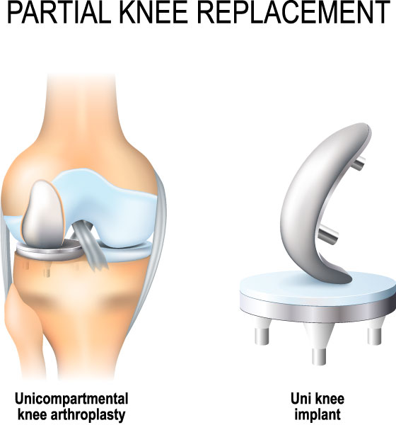 mako robotic partial knee replacement