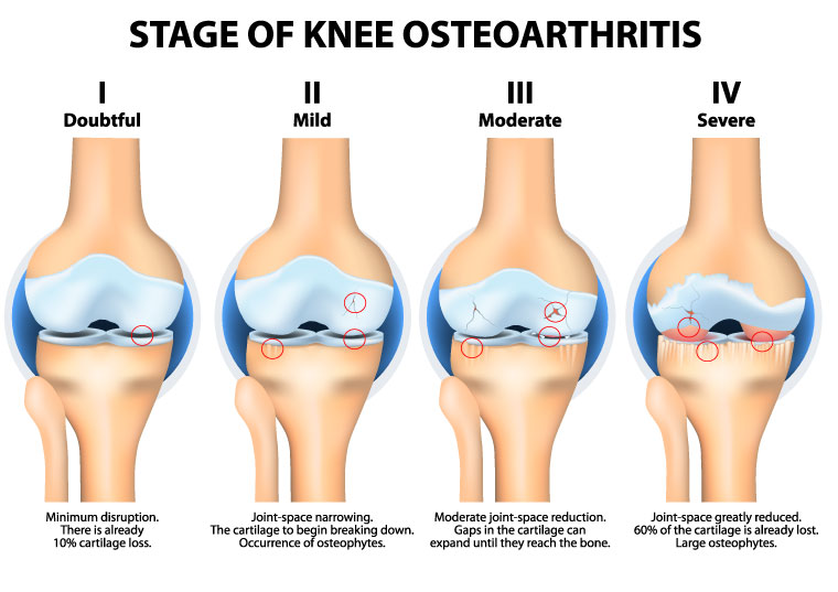 robotic knee surgery