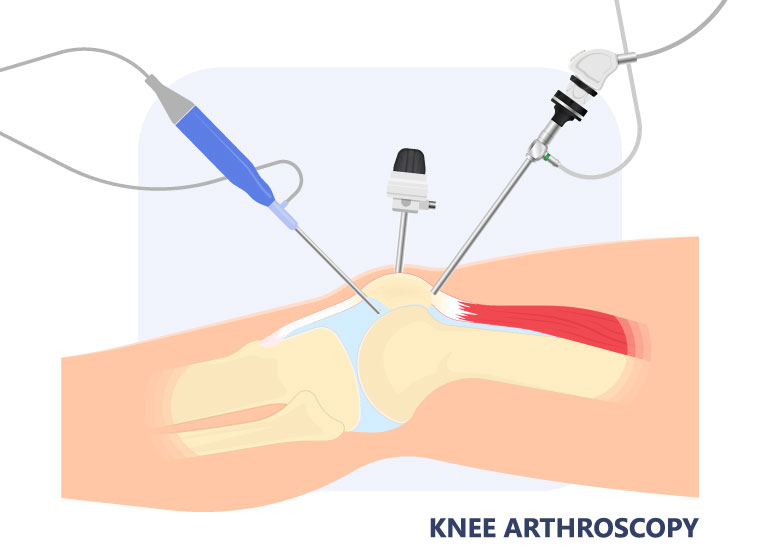 Robotic joint replacement MOATI